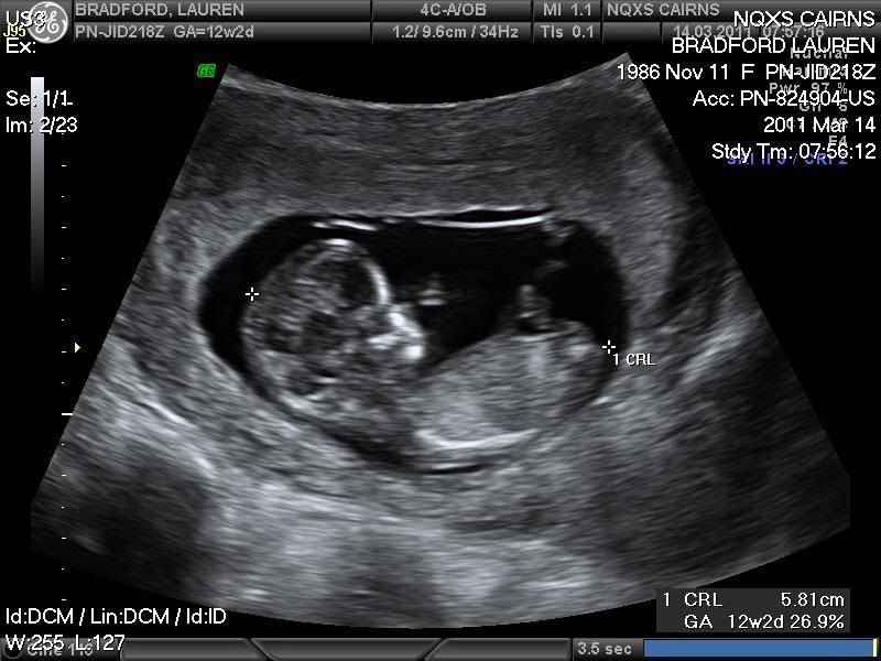 Healthy+heartbeat+at+12+weeks