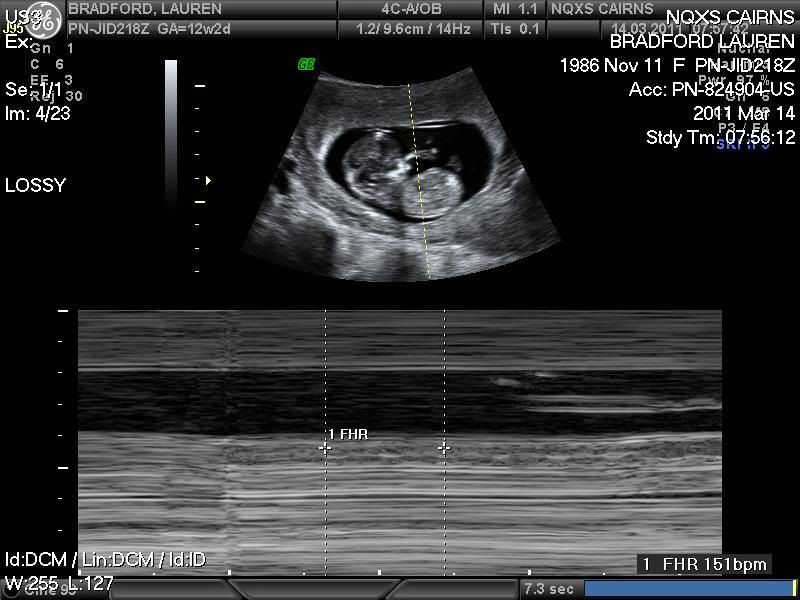 Healthy+heartbeat+at+12+weeks